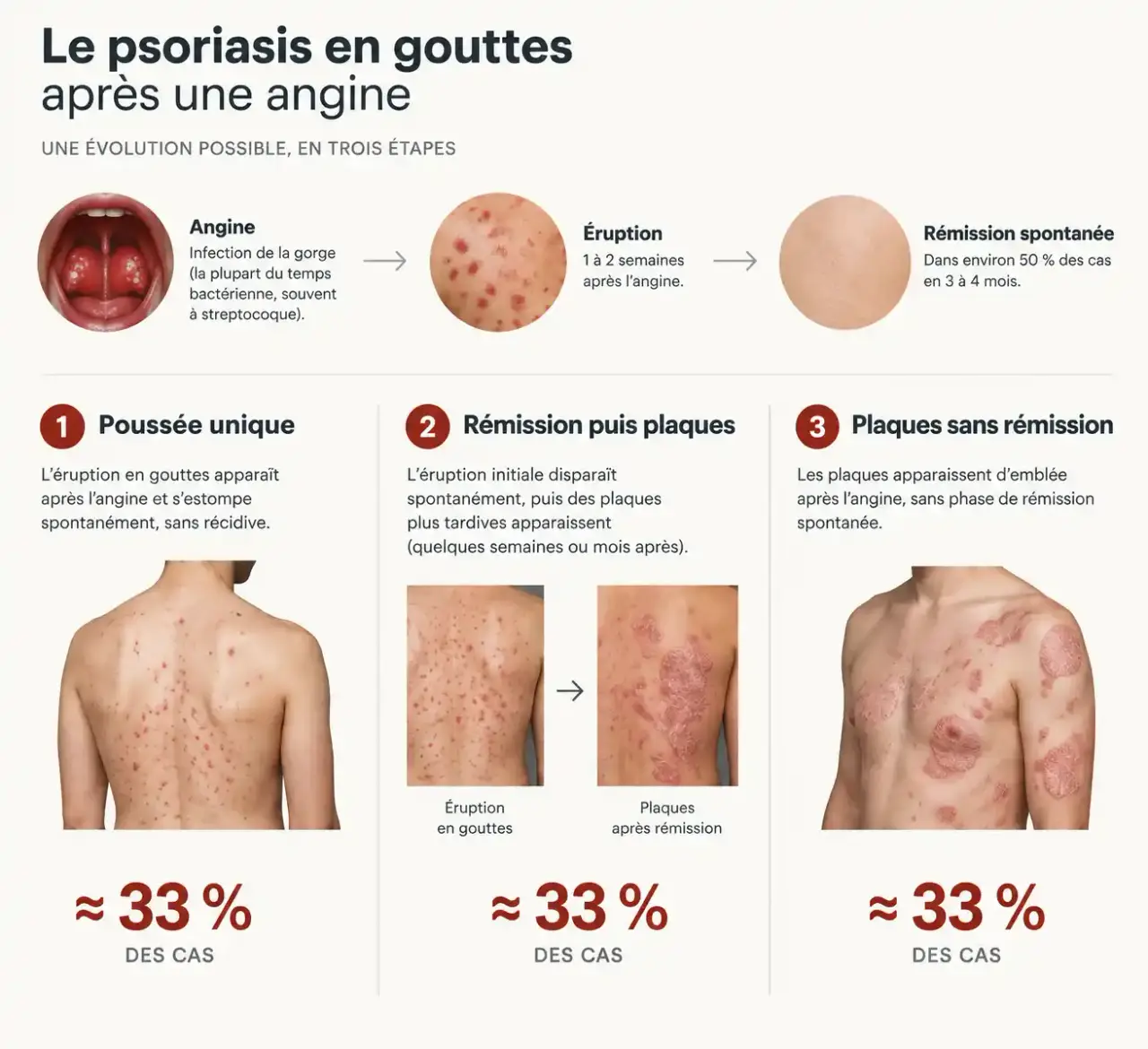 Schéma de l'évolution du psoriasis en gouttes : délai après l'angine, rémission spontanée et répartition des évolutions, utile pour choisir le traitement du psoriasis en goutte